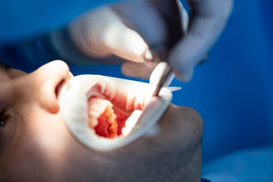 השתלת עצם – מתי ואיך עושים את זה? 9 pacient dental clinic while operation